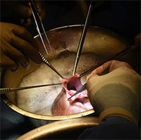 Bệnh nhân thứ 2 trên thế giới được cấy ghép tim lợn