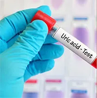 Top 10 cách "đào thải" acid uric một cách tự nhiên, ngừa gout hiệu quả: Nhiều người chưa biết để làm!