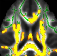 Mỡ bụng cảnh báo bệnh Alzheimer?
