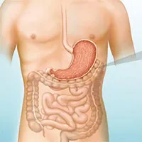 Bệnh u mô đệm đường tiêu hóa là gì?