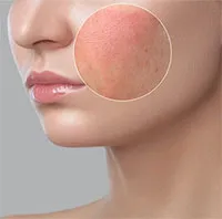 Tại sao da thường bị nổi mẩn ngứa khi gặp gió? 10 biện pháp giúp giảm triệu chứng nhanh chóng