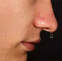 Tại sao bạn bị chảy nước mũi khi ăn?