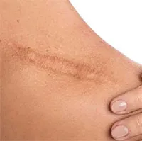 Mẹo chăm sóc vết thương giúp hạn chế sẹo