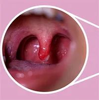 Lưỡi gà là gì? Lưỡi gà bị sưng là do đâu?
