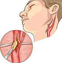 Triệu chứng và cách phòng ngừa hẹp động mạch cảnh - nguyên nhân âm thầm gây đột quỵ não