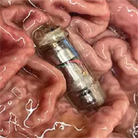 "Viên thuốc" công nghệ có khả năng tạo cảm giác no bụng