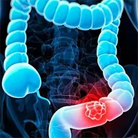 Đột phá trong nghiên cứu phát hiện sớm các khối u ung thư ruột