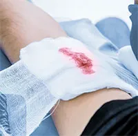 Nghiên cứu đột phá về phương pháp điều trị hiệu quả các vết thương lâu lành