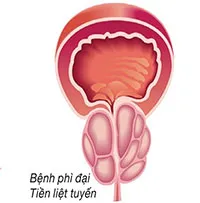Phì đại tiền liệt tuyến: Nguyên nhân, triệu chứng và cách điều trị