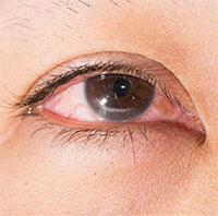 Tại sao viêm mũi xoang lại có thể gây mù mắt?