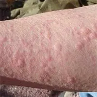 Giải mã căn bệnh hiếm gặp, không chữa được mang tên “bệnh ma cà rồng”