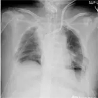 Bệnh phổi trắng: Nguyên nhân, triệu chứng và cách điều trị