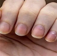 Dấu hiệu ít được chú ý trên móng tay có thể cảnh báo bạn về bệnh ung thư