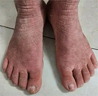 Người phụ nữ mắc bệnh da thế giới chỉ ghi nhận 100 ca