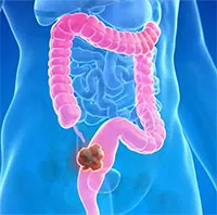 Kết quả thử nghiệm tích cực của thuốc giúp "tan chảy" khối u ung thư