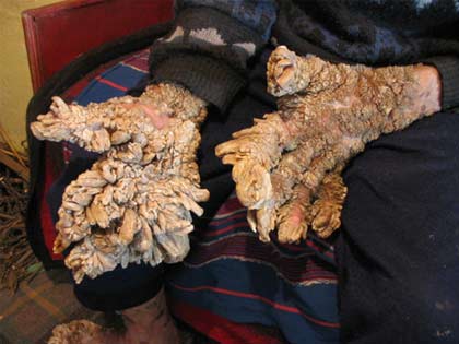 Một trường hợp “sừng hóa” hãi hùng ở châu Âu