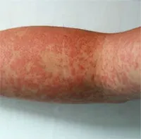 Trong lịch sử cổ đại, sốt xuất huyết đã “càn quét” các quốc gia thế nào?