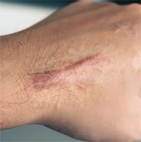 Vì sao sẹo tồn tại vĩnh viễn?