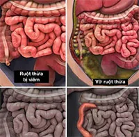 Vỡ ruột thừa: Dấu hiệu, nguyên nhân và cách điều trị