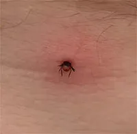 Phát hiện virus bí ẩn lây truyền qua bọ ve ở Trung Quốc