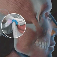 Biểu hiện và cách điều trị loạn năng thái dương hàm
