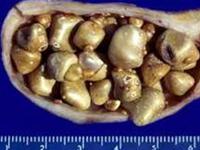 Sỏi mật: Nguyên nhân, triệu chứng và cách điều trị