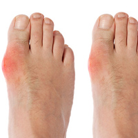 Bệnh gout đến từ đâu?