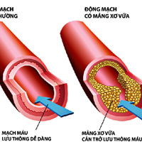 Rối loạn mỡ máu và cách điều trị không dùng thuốc