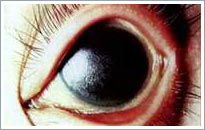 Bệnh khô mắt và những hiểm họa khó lường