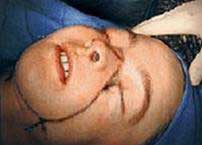 Chuyện tiếp về người phụ nữ được ghép mặt: Kinh ngạc!