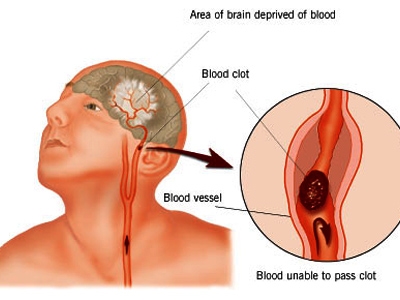 Cách nhìn mới về đột quỵ