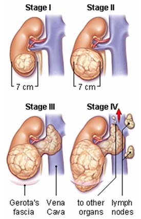 Hy vọng cho việc chữa trị ung thư thận