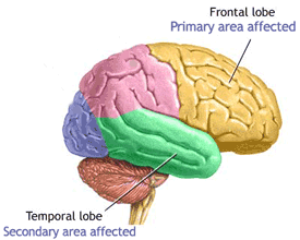 Protein chống lại bệnh Alzheimer's?