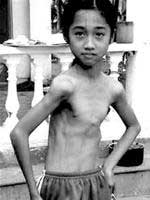 Bộ Y tế thành lập Hội đồng nghiên cứu bệnh teo cơ