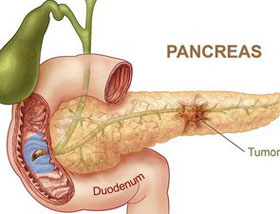 Phát hiện sớm ung thư tuyến tụy và ung thư mật