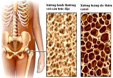 Loãng xương - Căn bệnh âm thầm