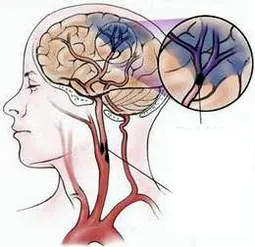 Phương pháp điều trị nhồi máu não bằng siêu âm