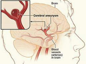 Dị tật về tim dễ bị chứng phình động mạch não