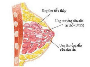 Các sản phẩm tẩy rửa làm tăng nguy cơ ung thư vú