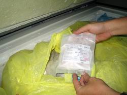 TP.HCM: Bảo quản xương sọ để cấy ghép