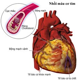 Phát hiện thêm hai gen liên quan đến bệnh tim