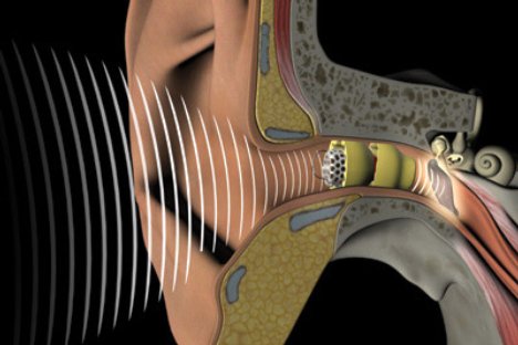 Thính giác liên quan đến tăng nguy cơ mất trí nhớ