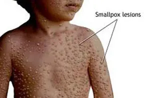 Nguy cơ phân tán virus đậu mùa qua vũ khí sinh học