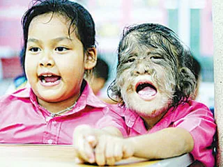 Đột biến gien biến người thành “sói"