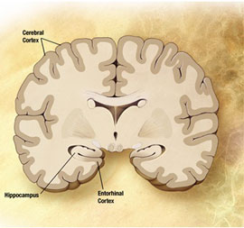 Bệnh Alzheimer có thể phòng ngừa được