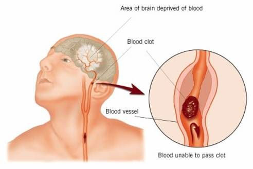 Hy vọng mới cho các bệnh nhân bị chứng đột quỵ