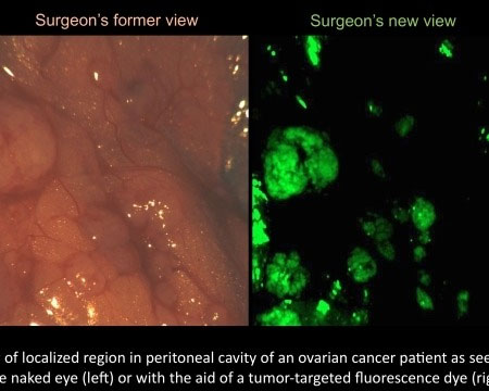 Công nghệ mới trong phẫu thuật ung thư buồng trứng