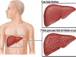 Thuốc mới giúp phục hồi cho bệnh nhân xơ gan