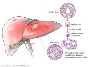 Công bố phát hiện quan trọng về bệnh ung thư gan
