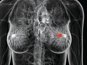 Xét nghiệm gene ATM giúp dự đoán trước ung thư vú